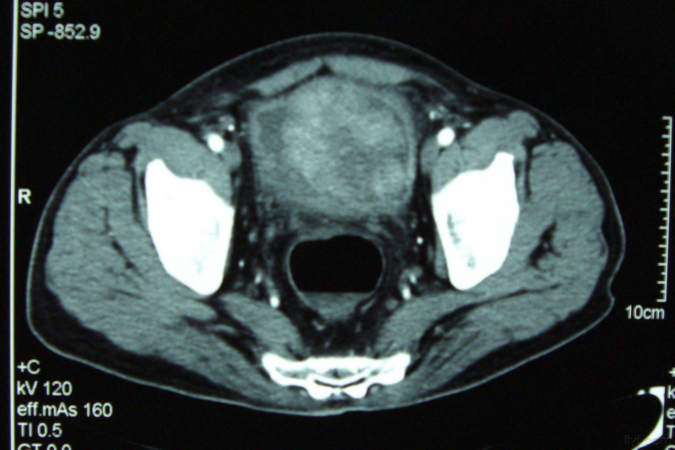 膀胱肿瘤ct图片