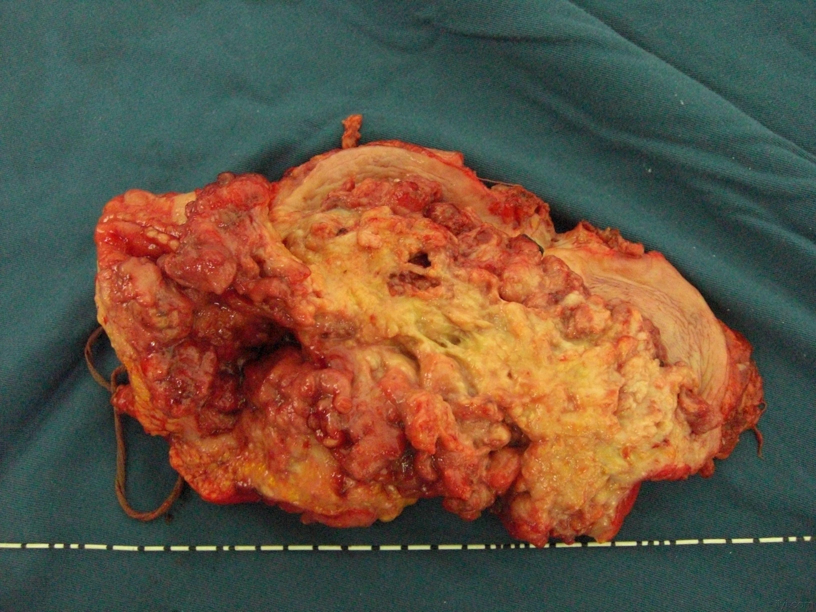 膀胱癌图片早期图片