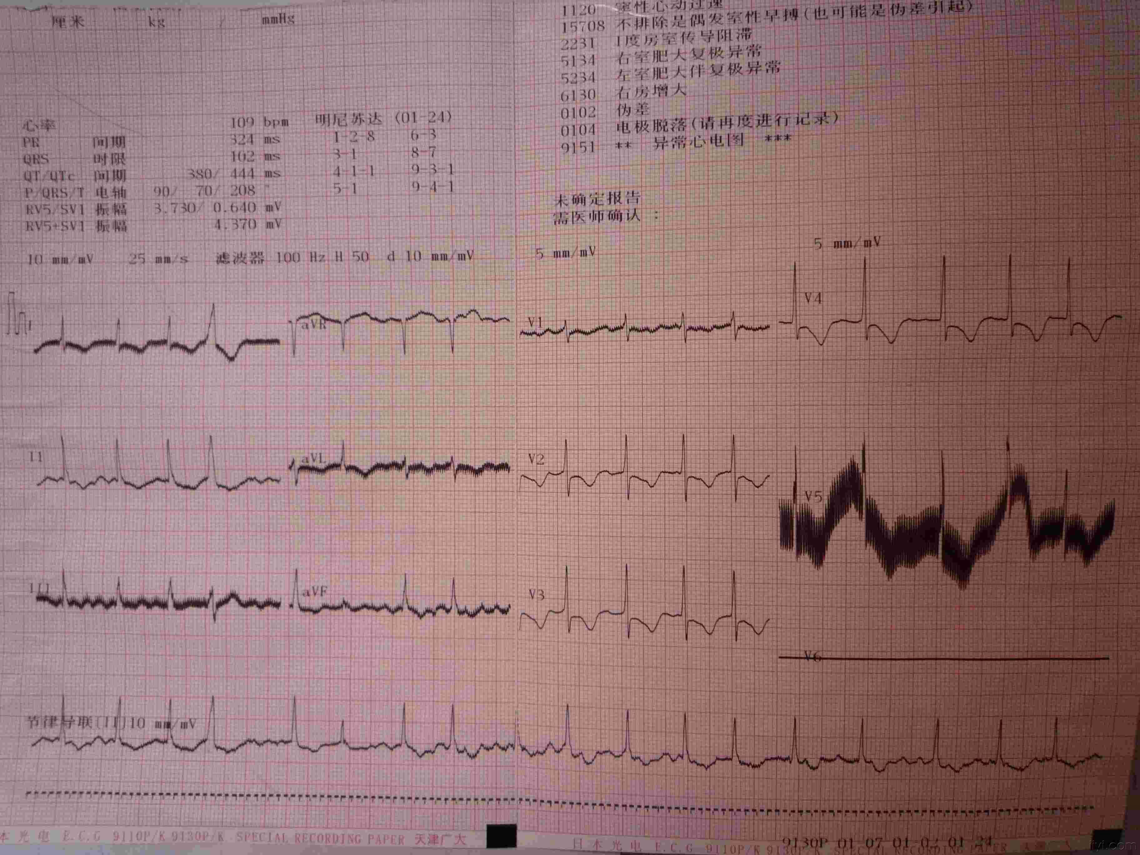 能确定心内膜下心梗嘛 心电图脑电图专业讨论版 爱爱医医学论坛