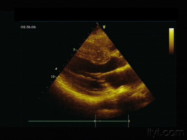 梗阻型肥厚性心肌病一例 - 超声医学讨论版 - 爱爱医医学论坛