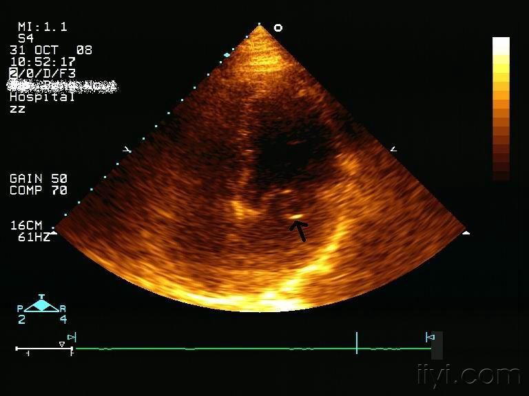 二尖瓣脱垂超声图像图片