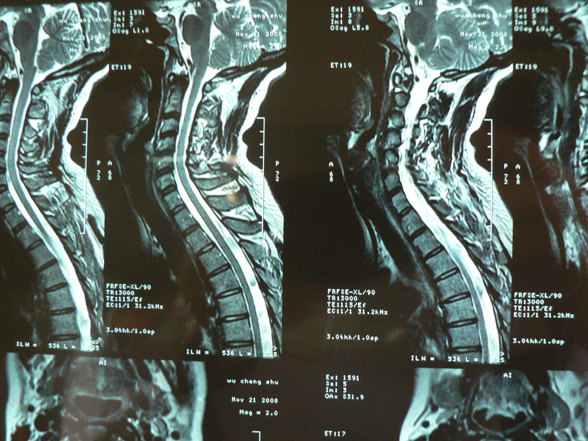 脊柱mri請閱片