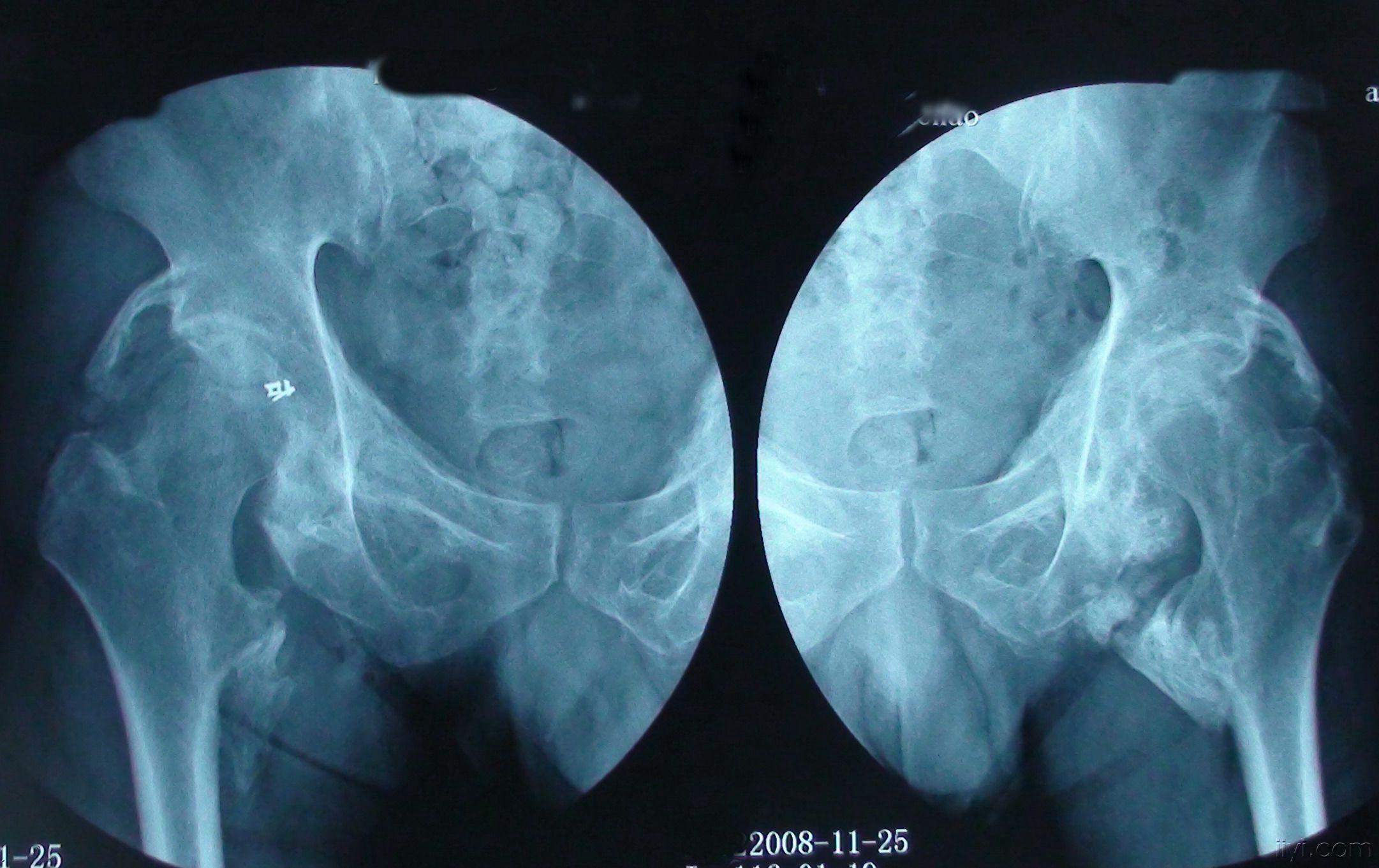 病例讨论罕见的双侧髋关节外伤后骨化性肌炎