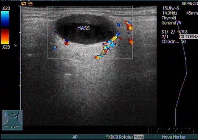 腮腺囊肿超声图片图片