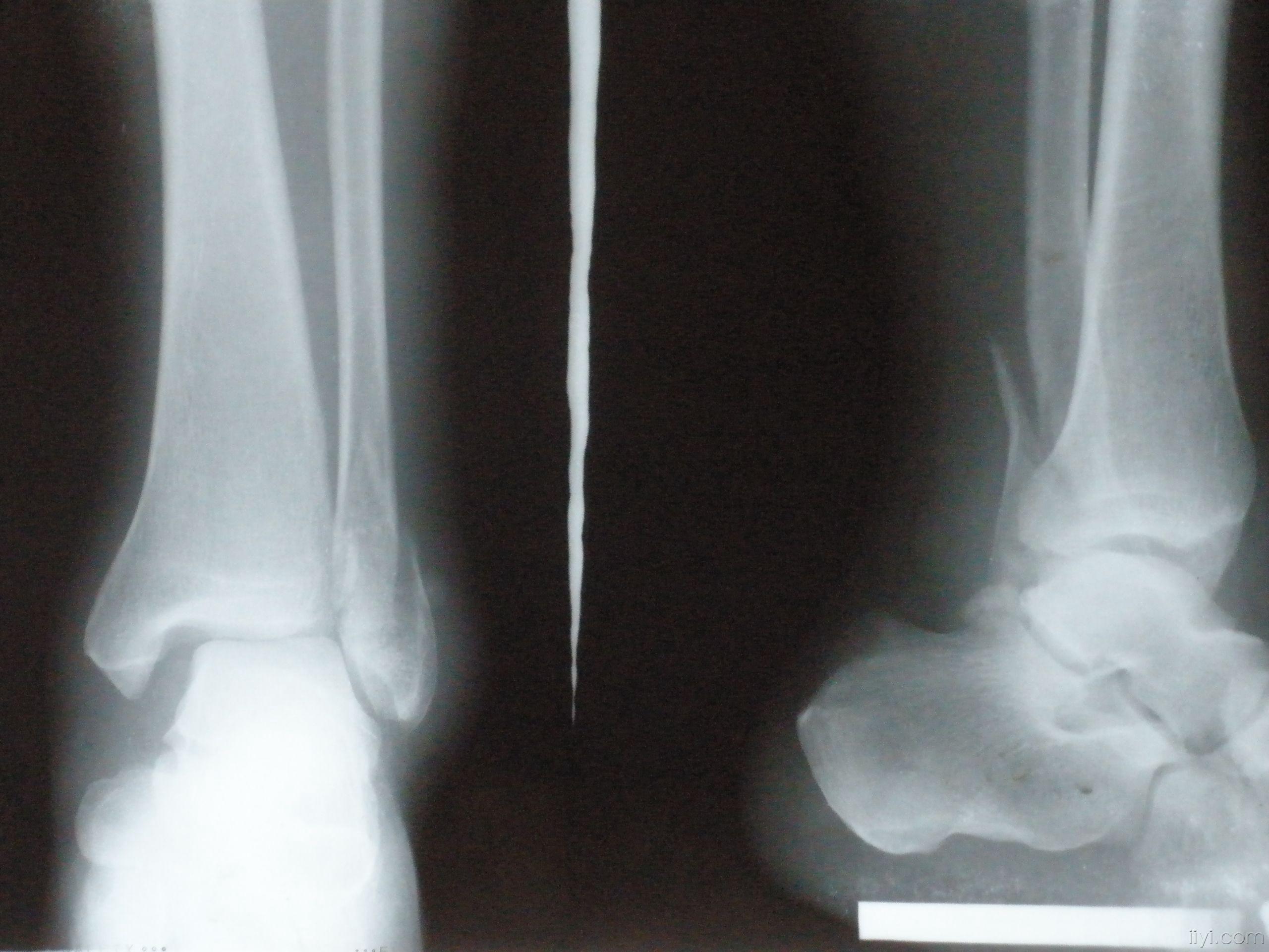 自制外固定架固定外踝骨折伴距骨半脫位