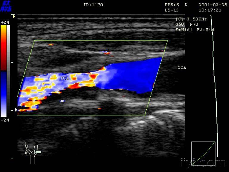 颈动脉体瘤超声表现图片