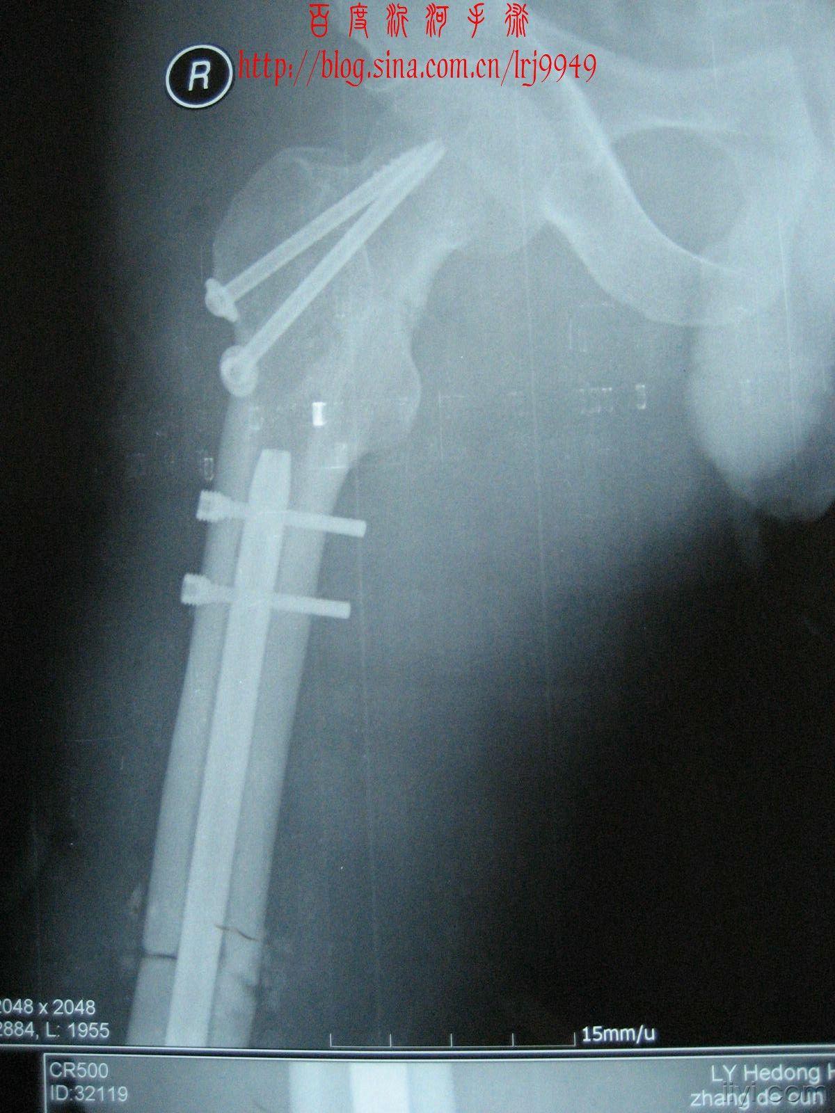 一例少见的股骨骨折