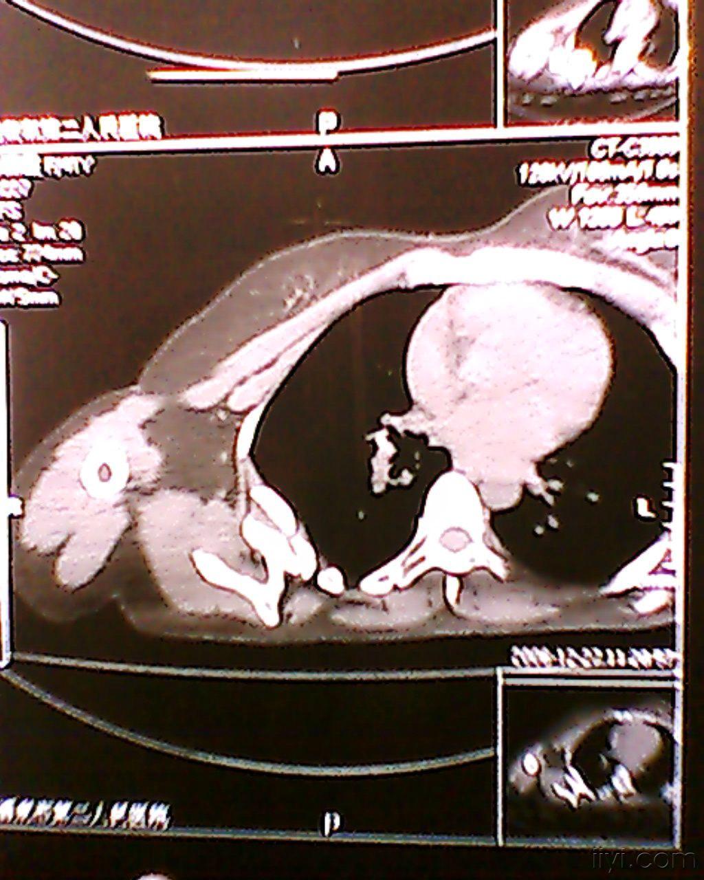 肩胛骨恶性肿瘤的图片图片