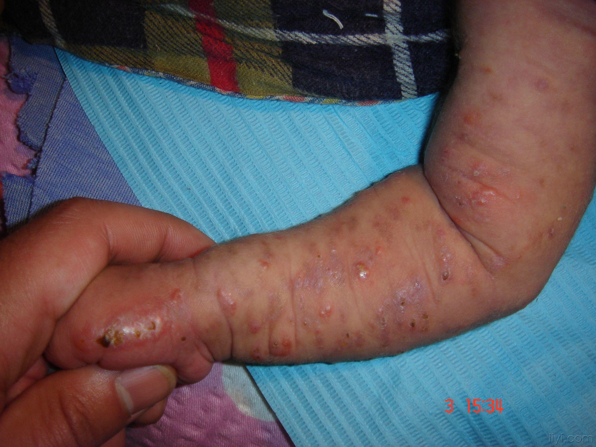 色素失禁症红斑水疱期