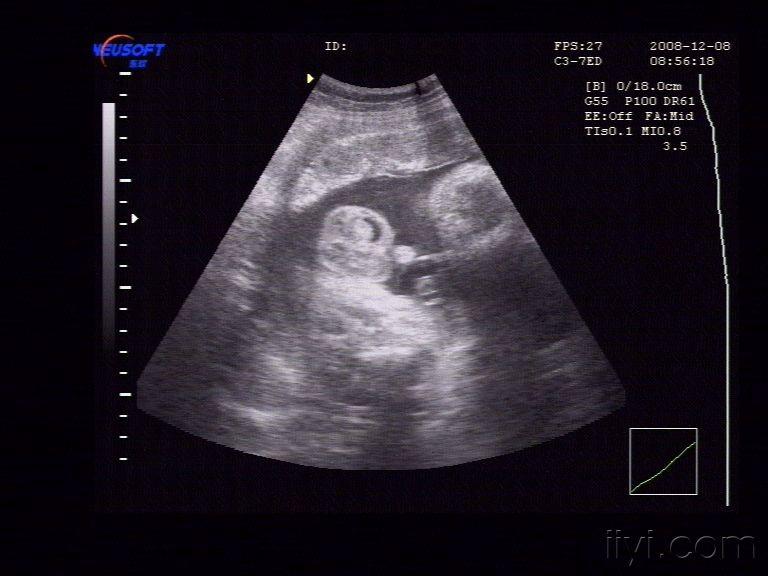 胎儿核磁的蛋蛋图像图片