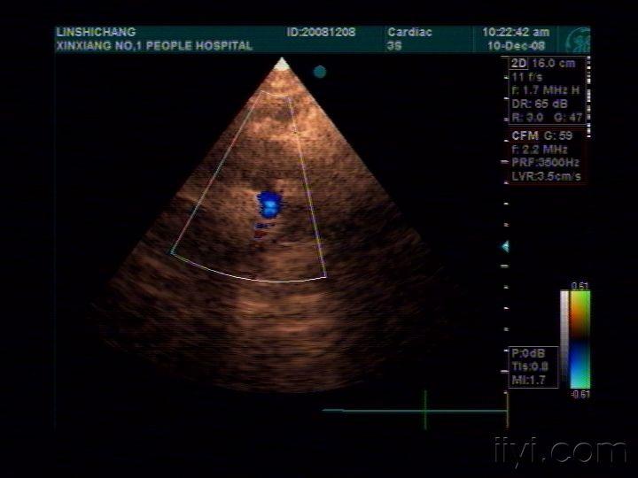 永存动脉干一例 超声医学讨论版 爱爱医医学论坛
