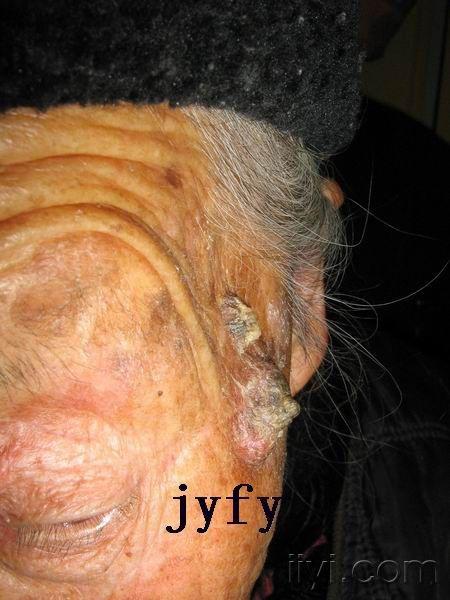 辞旧迎新2-高分化鳞癌所致皮角 - 皮肤及性传播疾