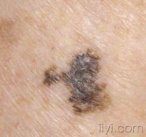 恶性黑色素瘤早期图片图片