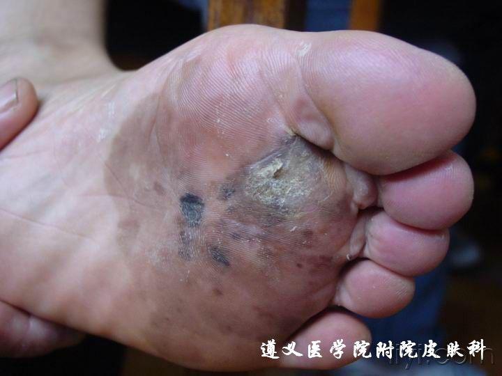 恶性黑色素瘤专辑