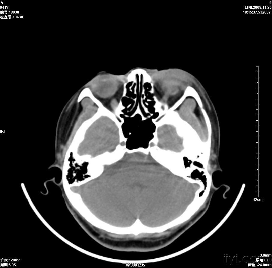 晶状体移位ct病例