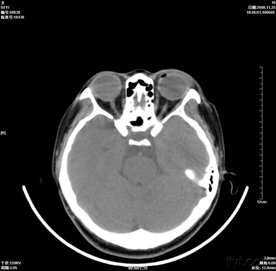 晶状体移位ct病例