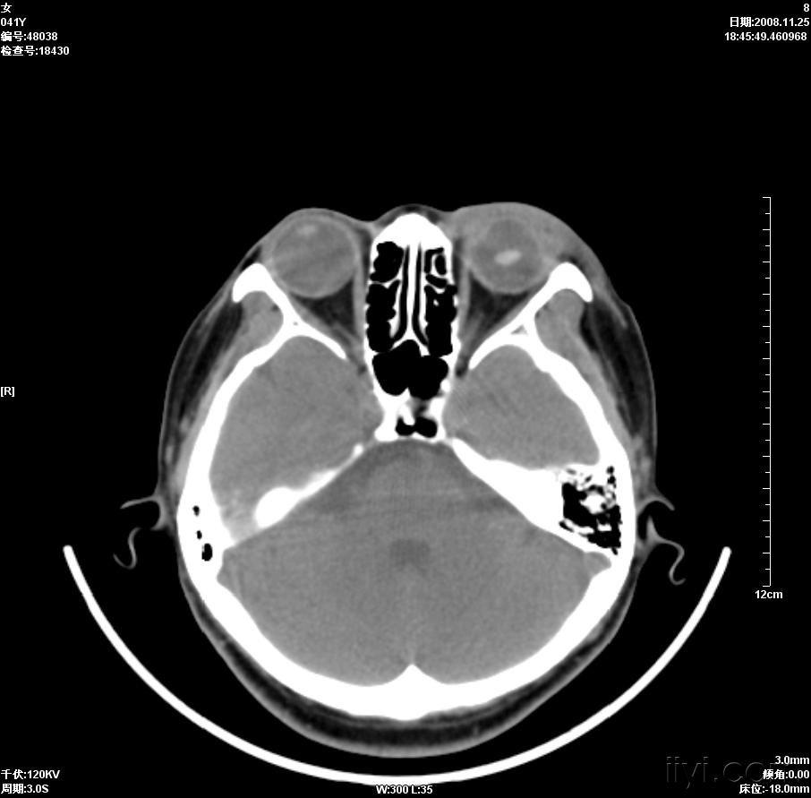 晶状体移位ct病例