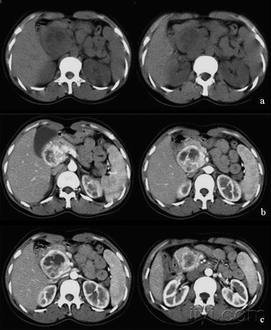 非功能性胰岛细胞瘤
