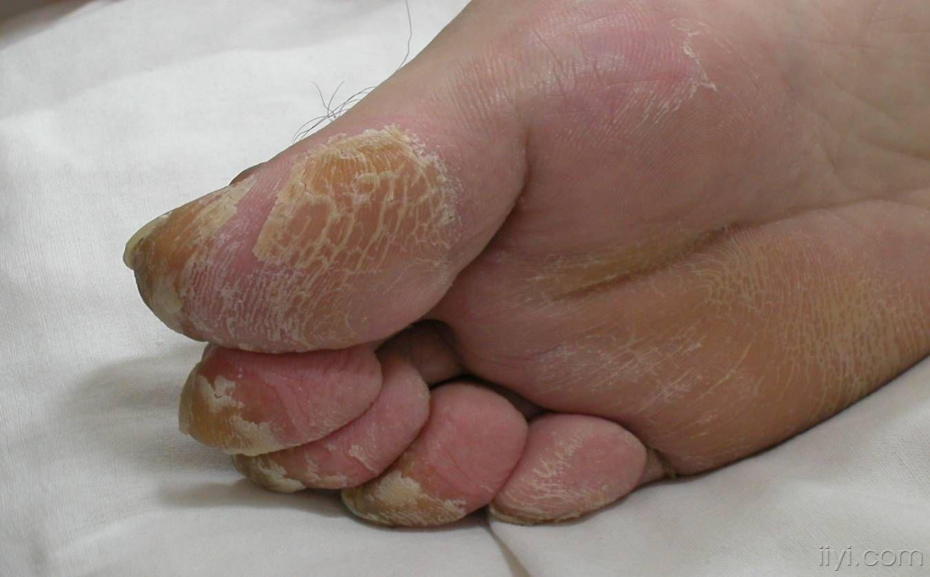 reiter 综合症皮疹