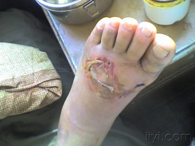 病例讨论左足第1234跖骨骨折