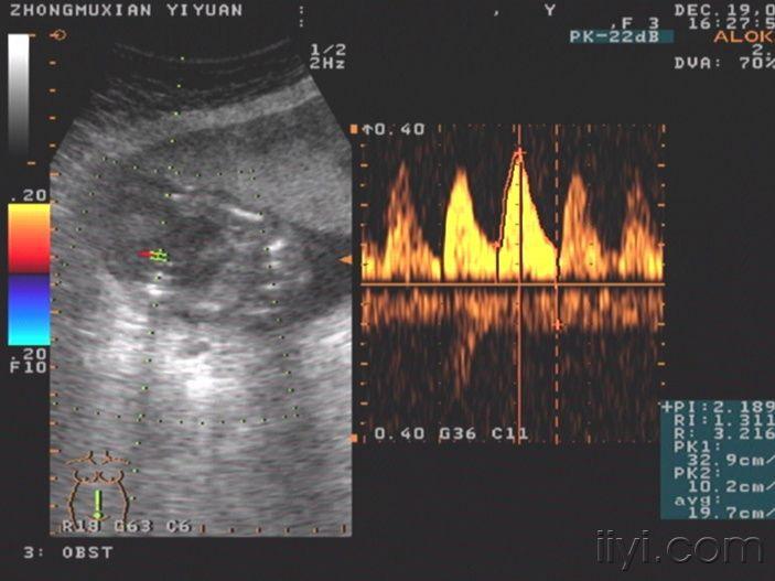 柠檬头合并脊柱裂一例