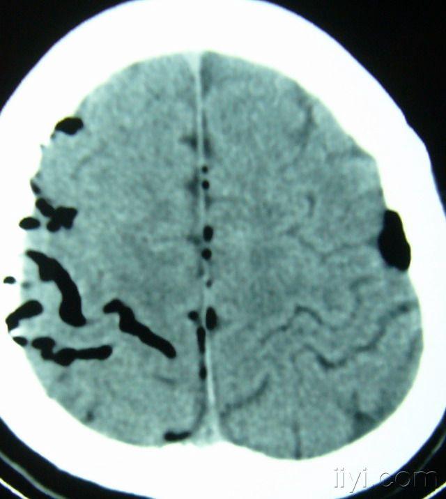 少见的颅内积气