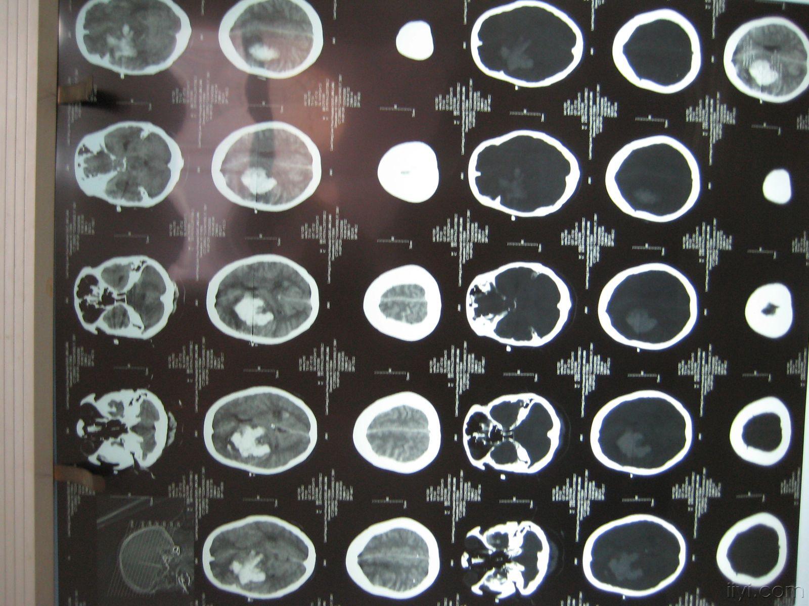 家属积极,做好充分交代后准备手术,术前复查ct