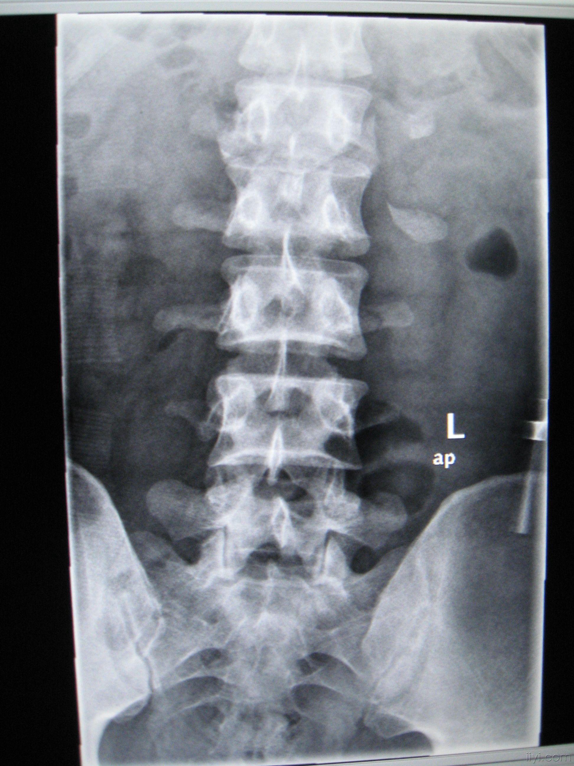 腰椎片子正常图片图片