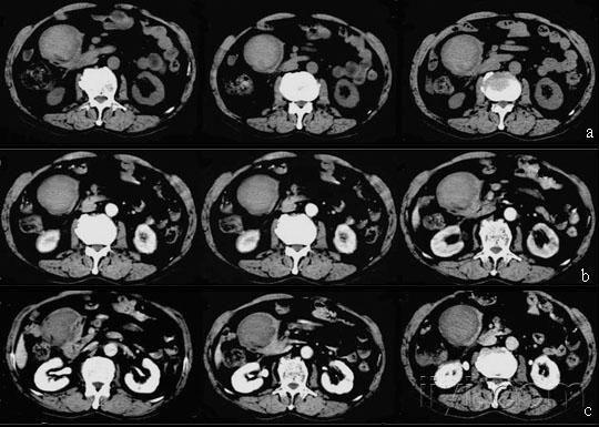 十二指肠降部肠壁血肿