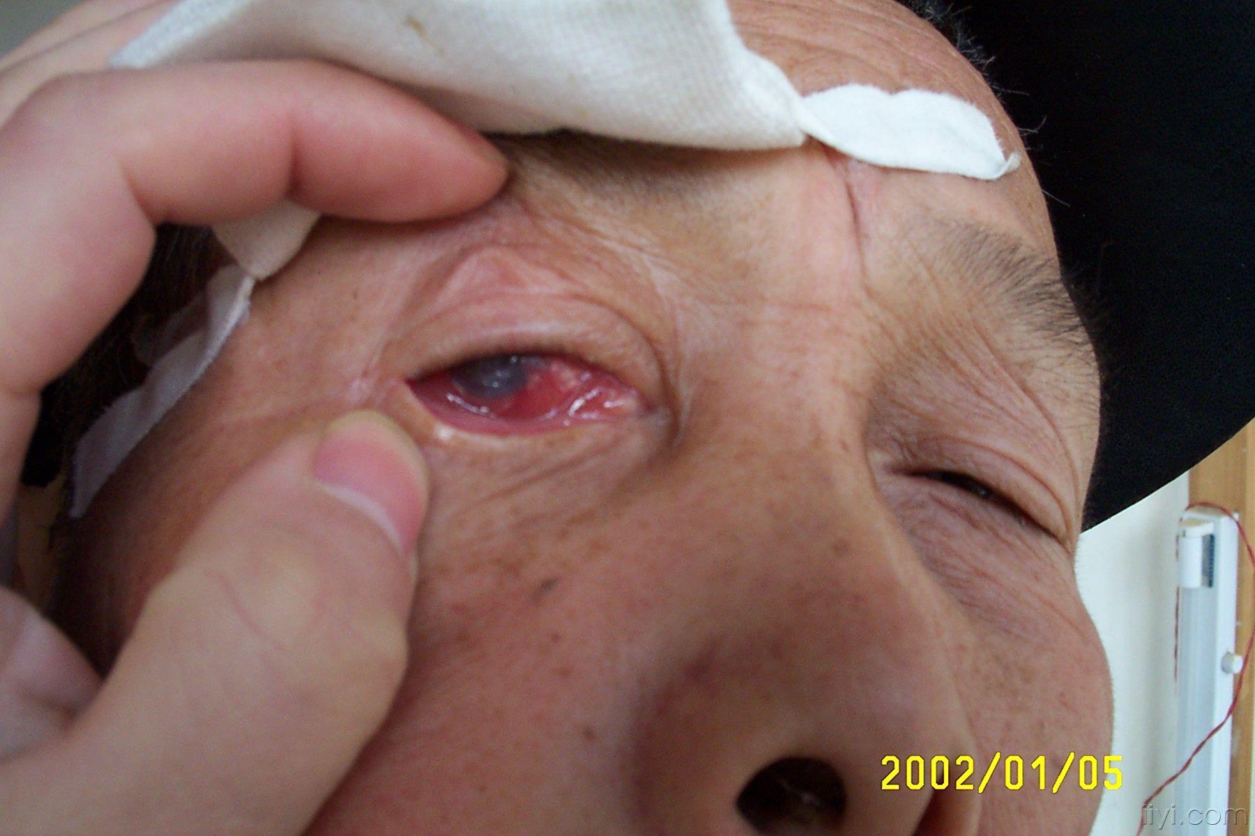 角膜炎瘢痕图片图片