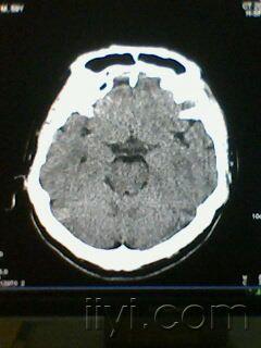 脉络膜裂囊肿ct影像图片