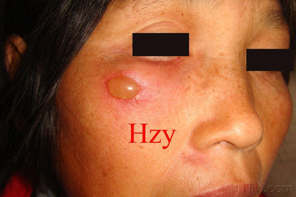 右脸部一大疱二天