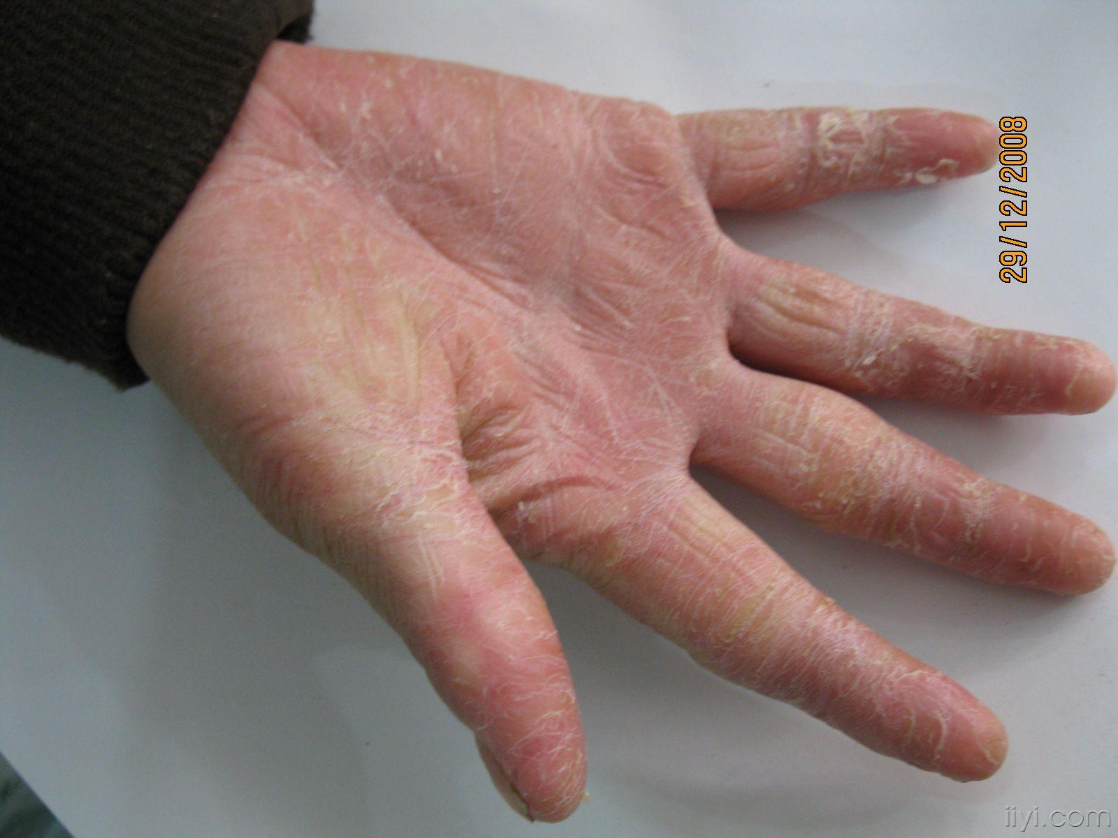 典型 的 进行性 指掌角皮症 - 皮肤及性传播疾病讨论版 - 爱爱医医学