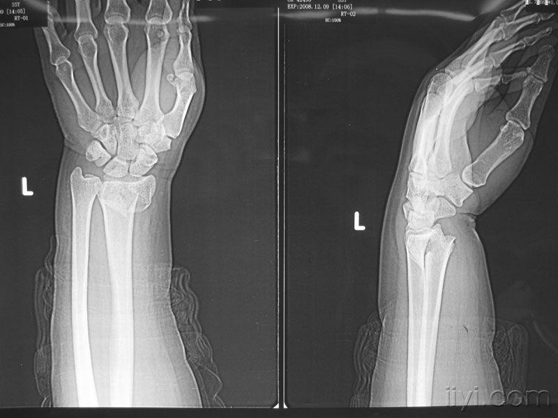 colles骨折正面图片