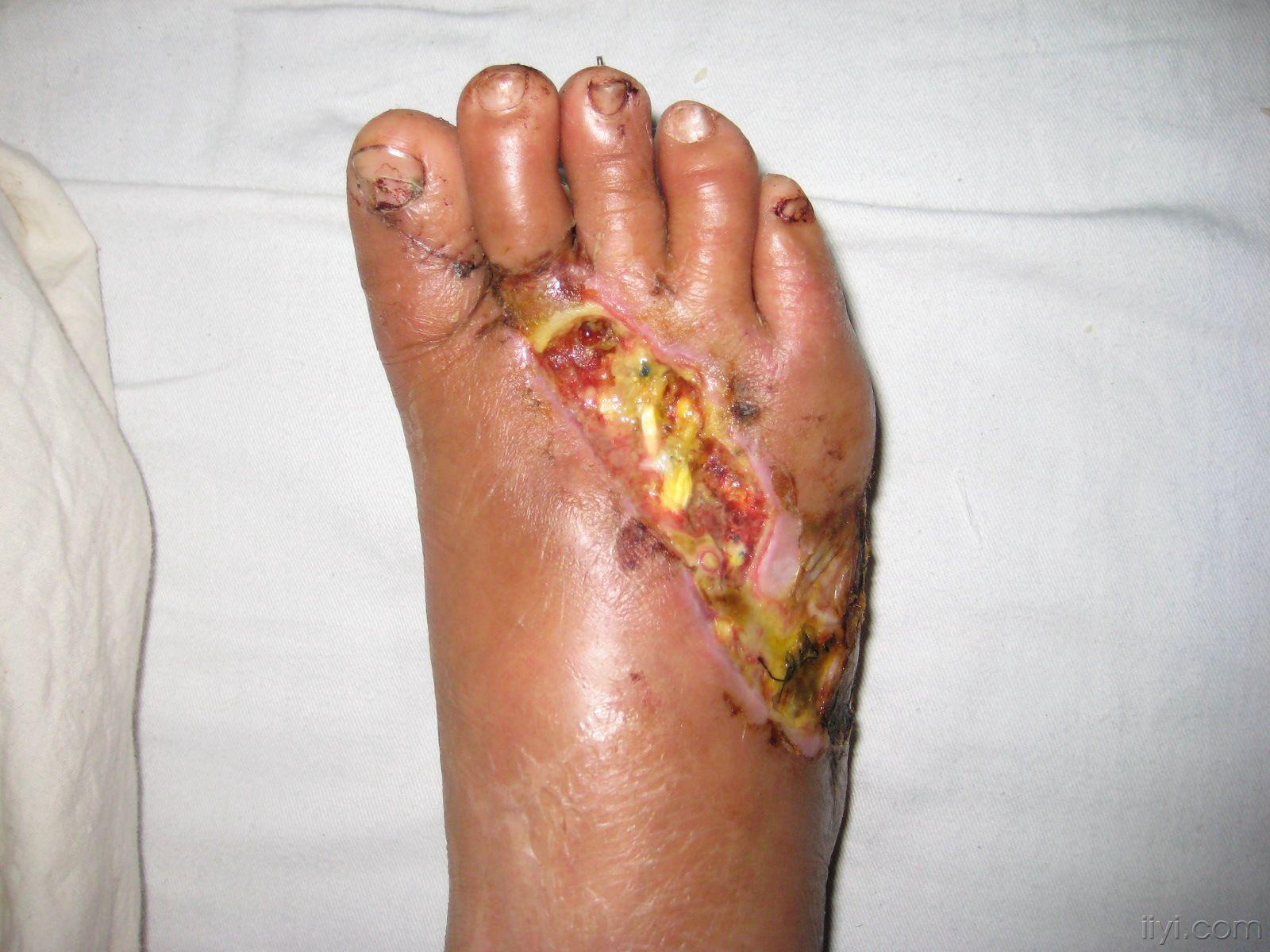 遇到一足背创口部分皮瓣坏死,请教治疗方法