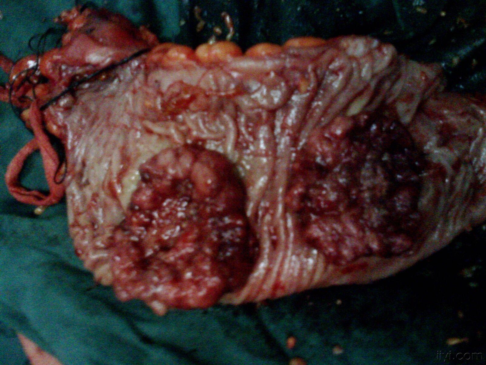 降结肠肿瘤图片