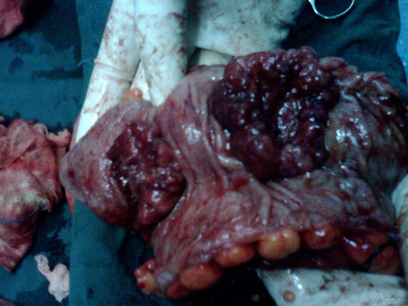 乙状结肠重复癌一例照片
