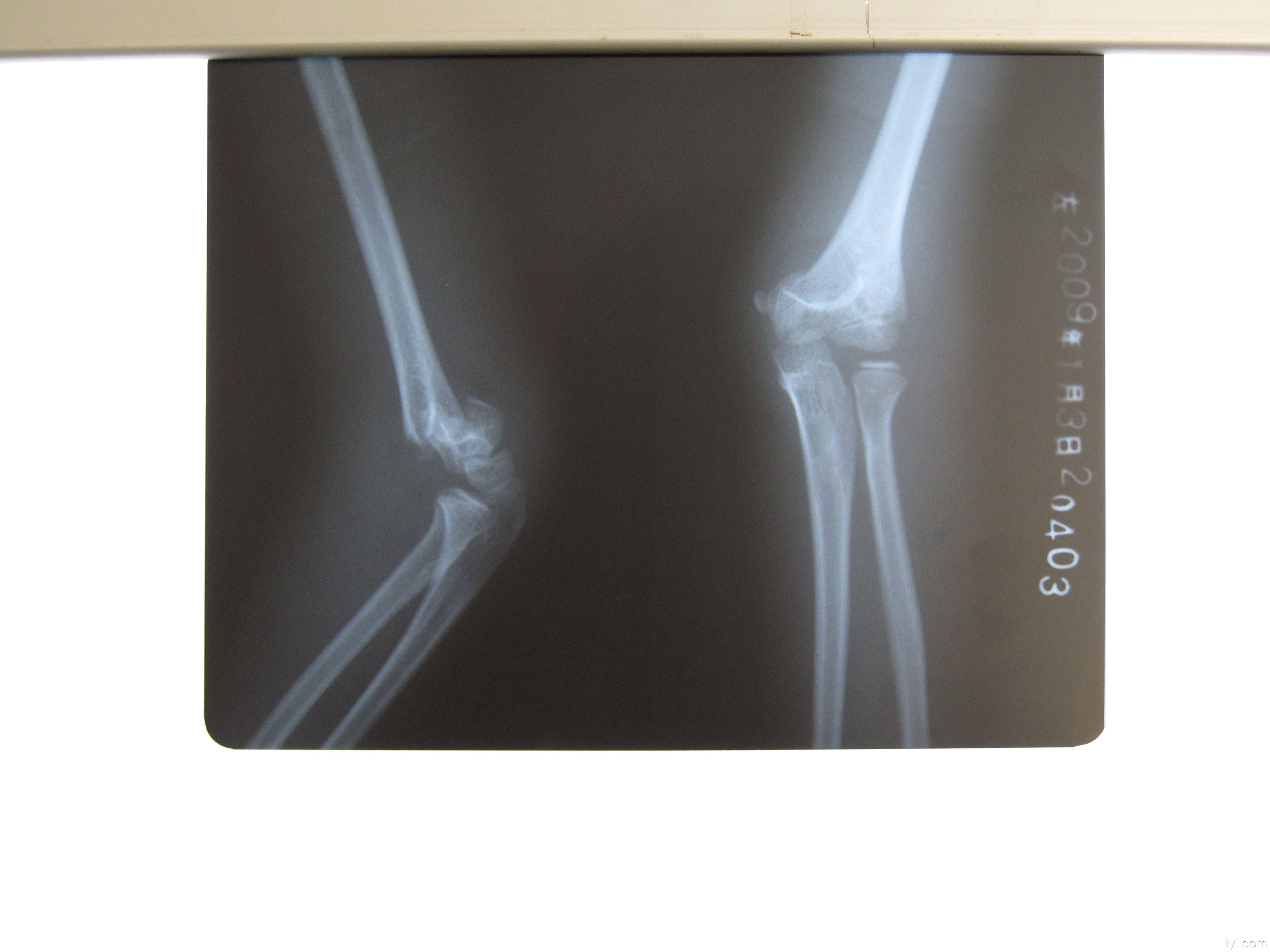 伸直型肱骨髁上骨折图片