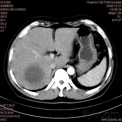 肝脓肿影像图片