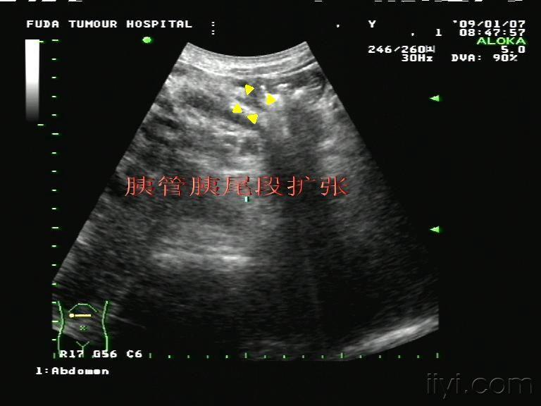 胰腺癌彩超图片