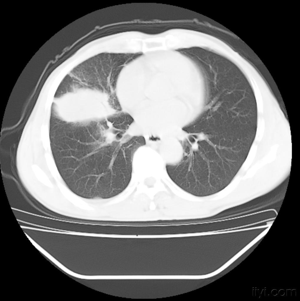 肺腺癌CT图片图片