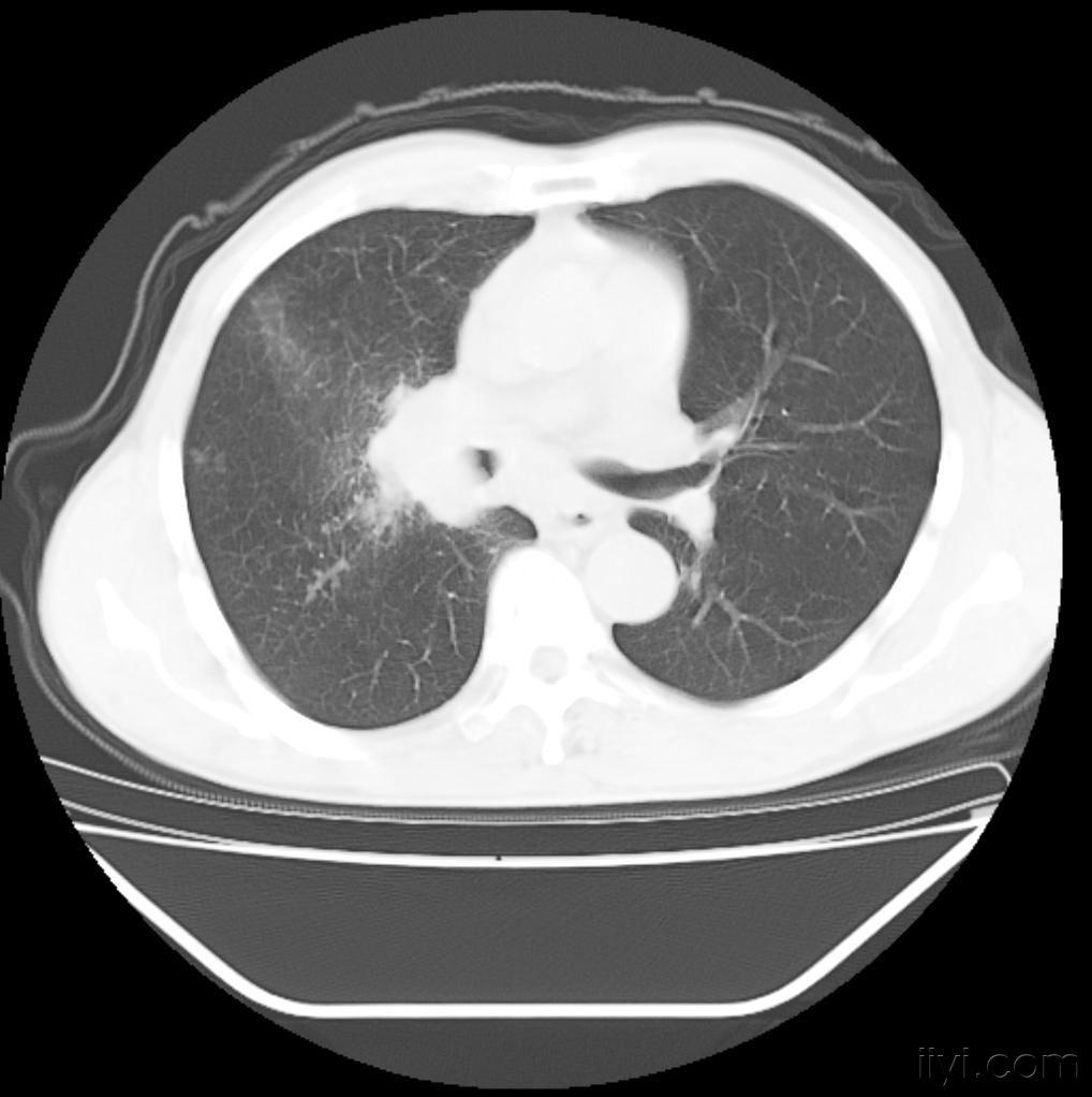 肺癌ct片 ! - 醫學影像學討論版 - 愛愛醫醫學論壇