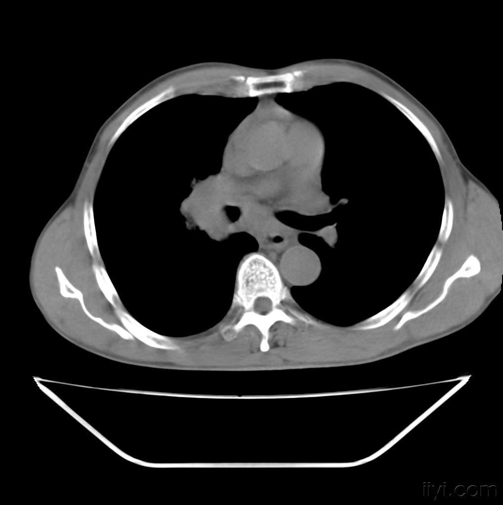 肺癌ct片 ! - 医学影像学讨论版 - 爱爱医医学论坛