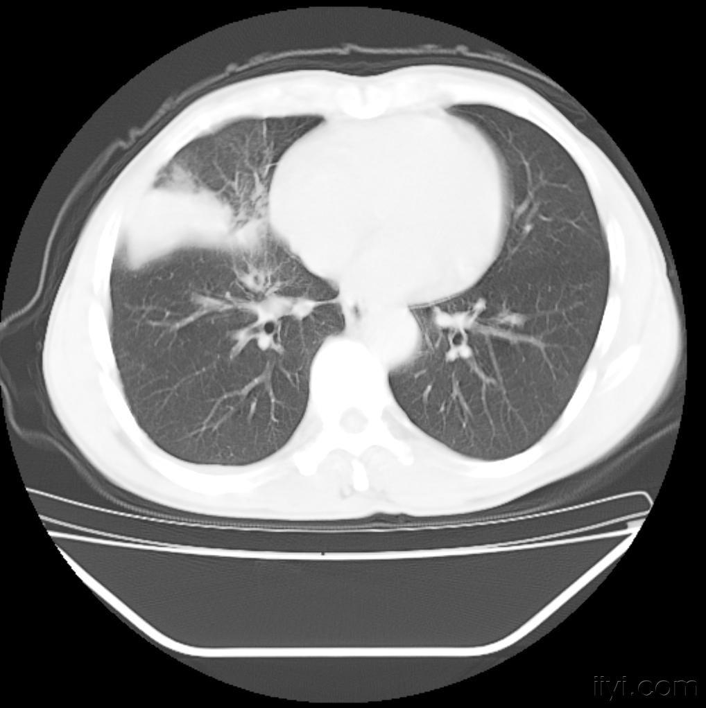 肺癌ct片 ! - 医学影像学讨论版 - 爱爱医医学论坛