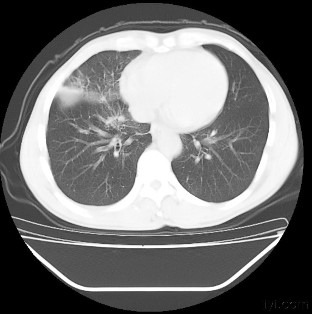 肺癌增强ct图片图片