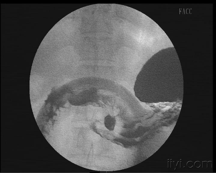 早期胃癌的片子图片
