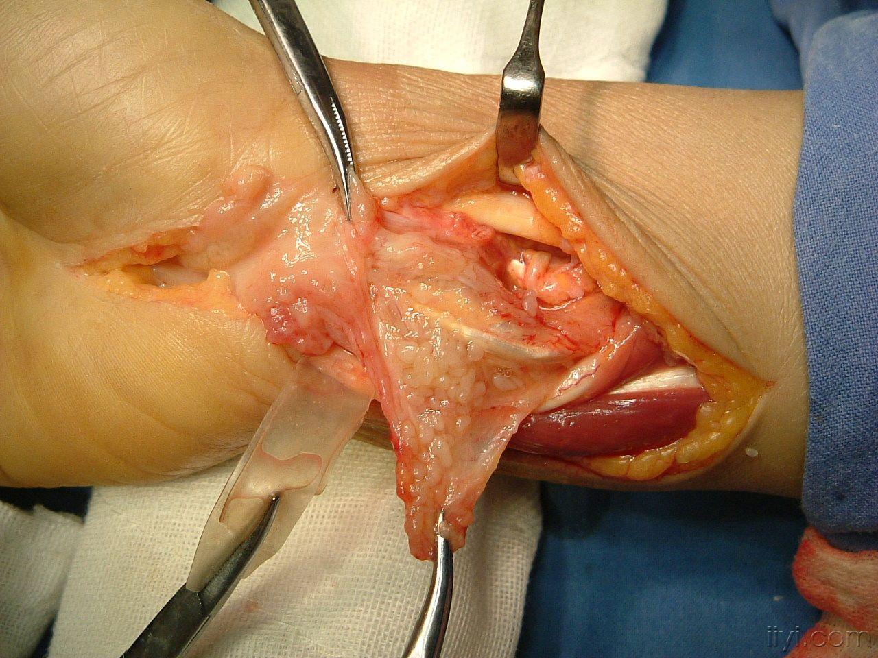 结核性滑膜炎2例图片