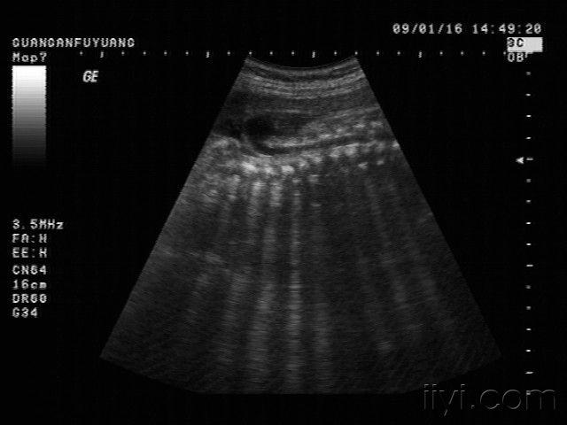 四维彩超脊柱裂图片图片