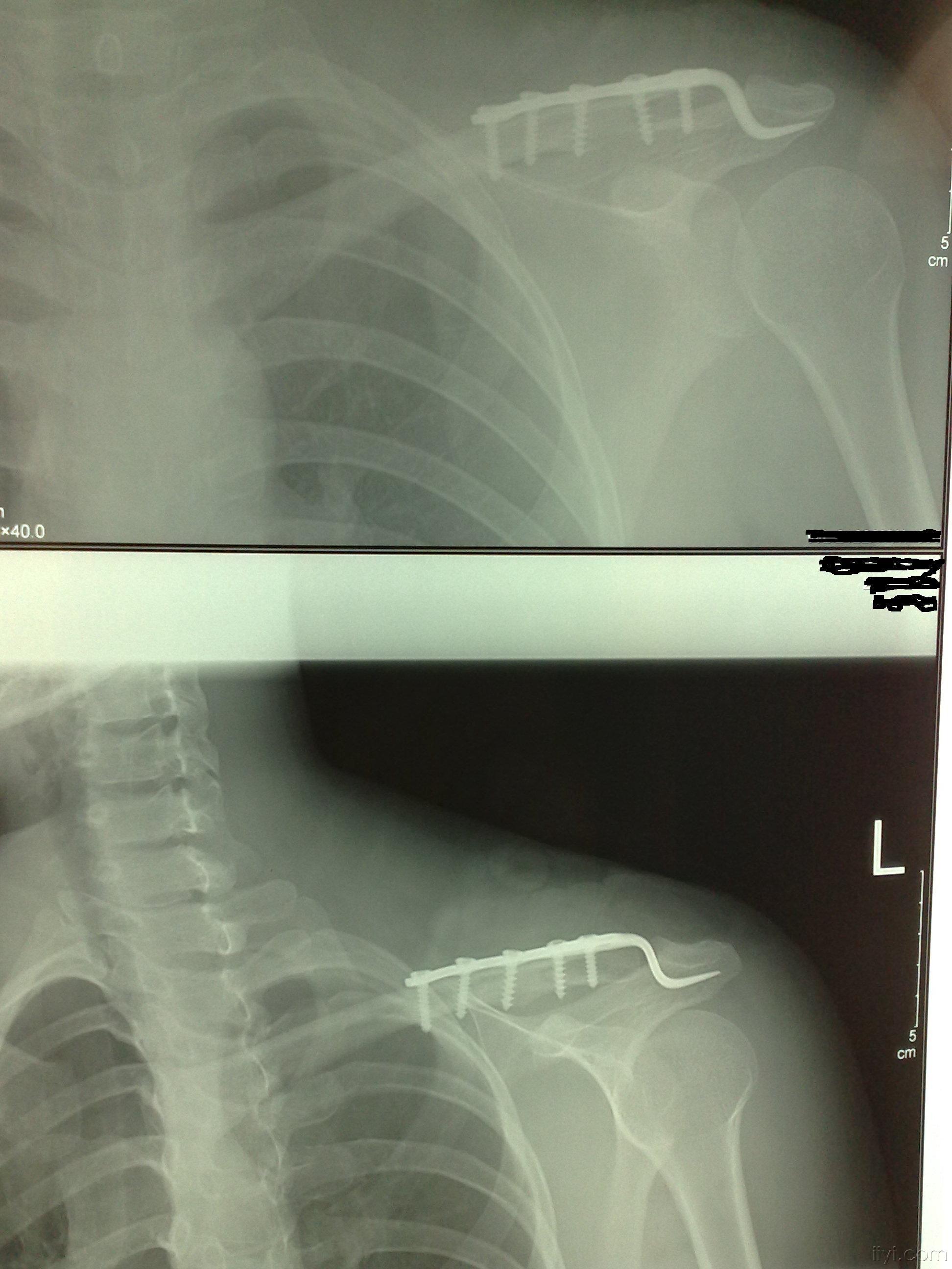 左锁骨远端骨折图片图片