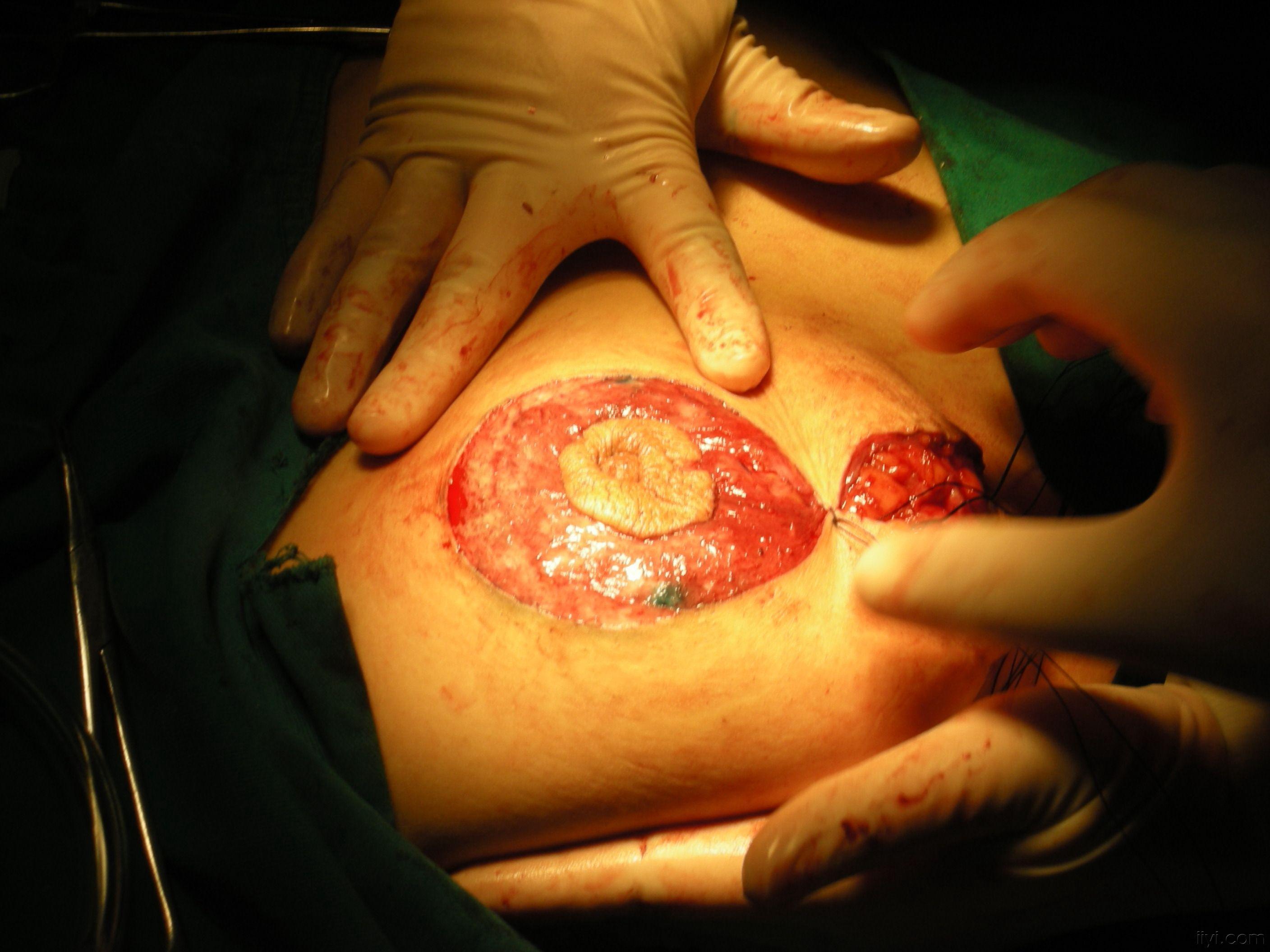女性乳房手术图片